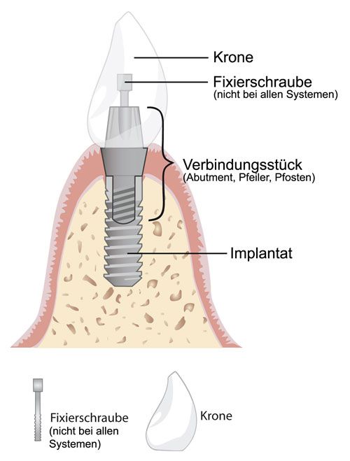 Was ist ein Implantat? - Zahnarzt Heidelberg, Dr. Bodem